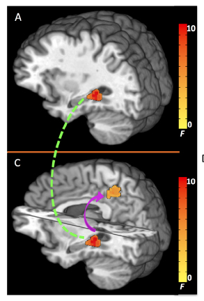 Basal Hippocampal Activity and Its Functional Connectivity Predicts Cocaine Relapse.